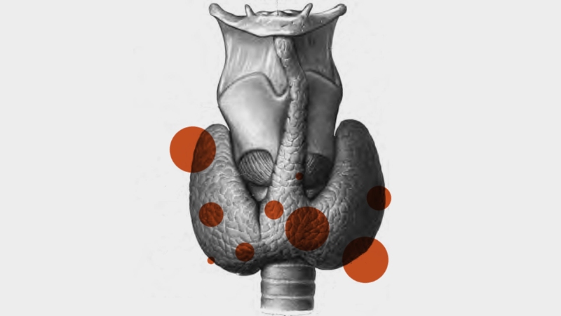Nódulo tiroideo ¿Qué es, cómo saber si es maligno, cuándo operar