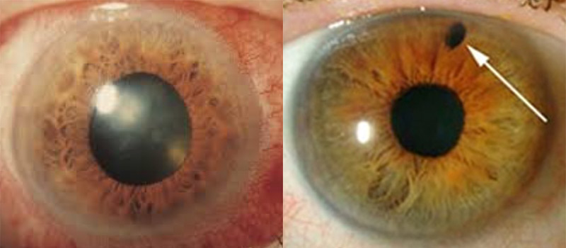 Crisis del glaucoma agudo: Síntomas del glaucoma agudo, tratamiento y consecuencias